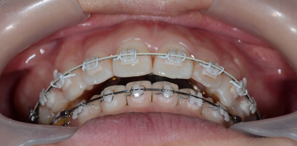 上の歯列全体を後方へ押す前の歯並び(前歯部を下方から確認)