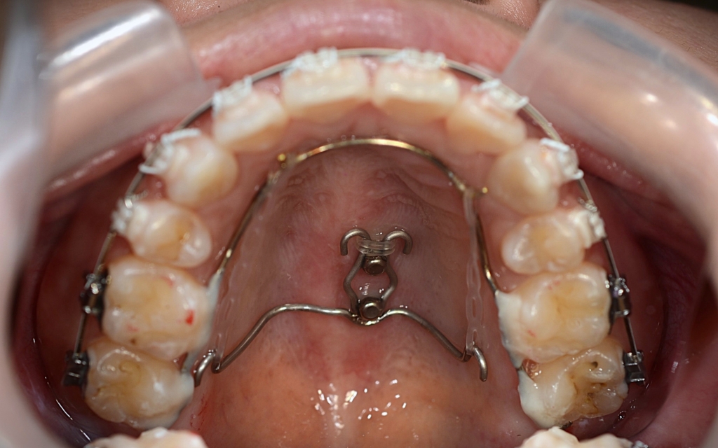 アンカースクリューを用いた矯正治療