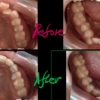 出っ歯でデコボコを矯正した治療前後の歯並びの変化の比較