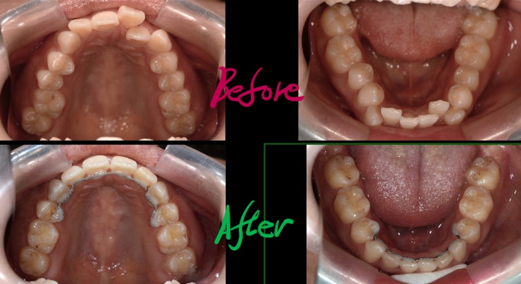 出っ歯でデコボコを矯正した治療前後の歯並びの変化の比較