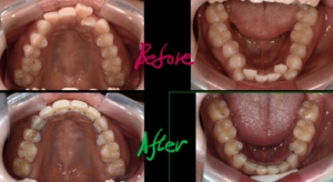 出っ歯でデコボコを矯正した治療前後の歯並びの変化の比較