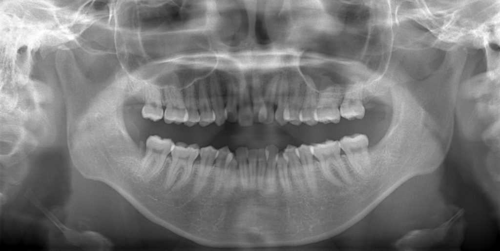 出っ歯でデコボコの矯正前の顎全体のレントゲン写真