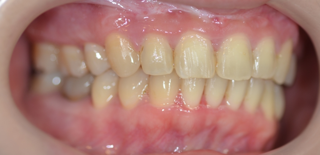 ガミースマイルで出っ歯の矯正後の歯並び