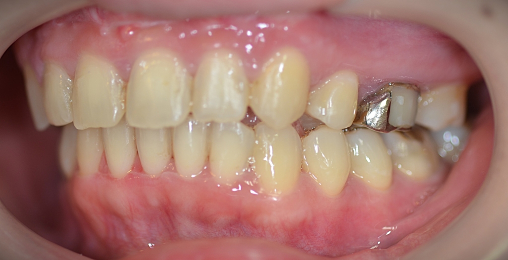 ガミースマイルで出っ歯の矯正後の歯並び