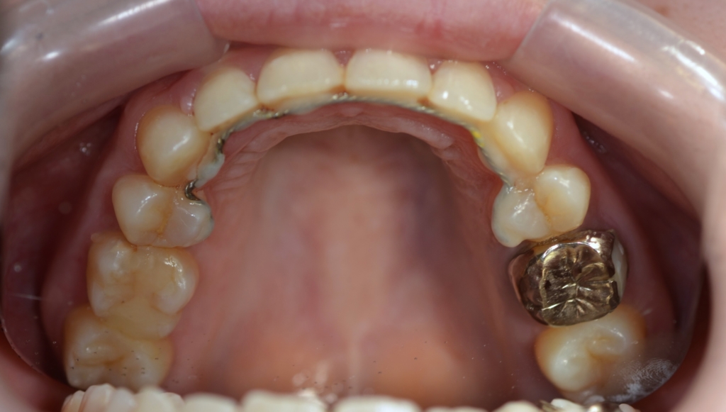 ガミースマイルで出っ歯の矯正後の歯並び