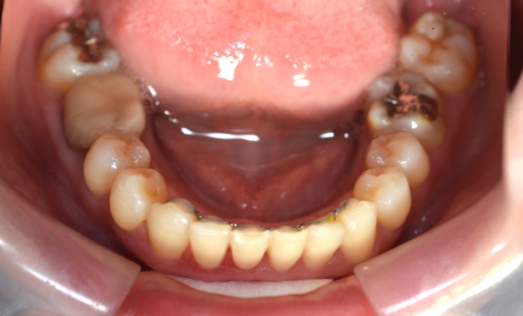ガミースマイルで出っ歯の矯正後の歯並び