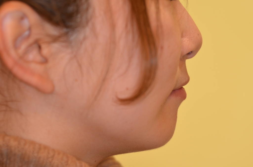 ガミースマイルで出っ歯の矯正後の横顔と口元