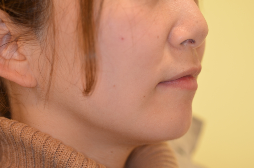 ガミースマイルで出っ歯の矯正後の横顔と口元