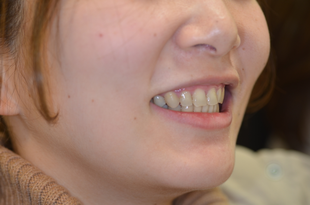 ガミースマイルで出っ歯の矯正後の笑顔