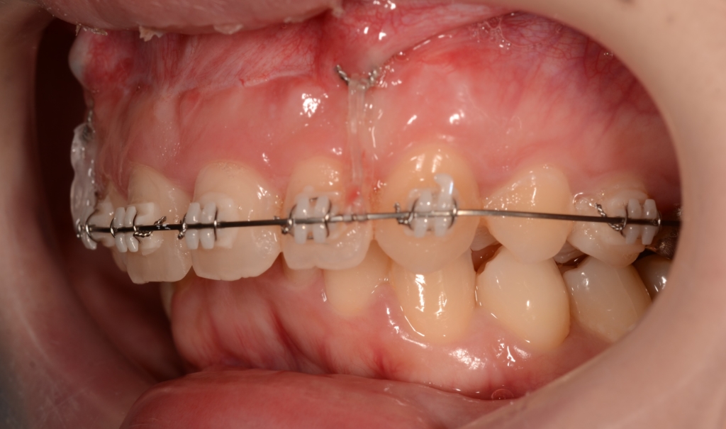 アンカースクリューを用いた矯正治療