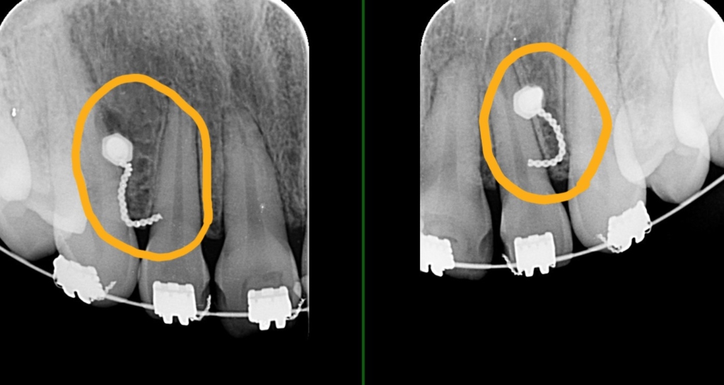 上顎前歯部にアンカースクリューを植立