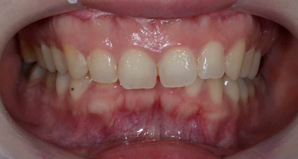 ガミースマイルで出っ歯の矯正前の歯並び