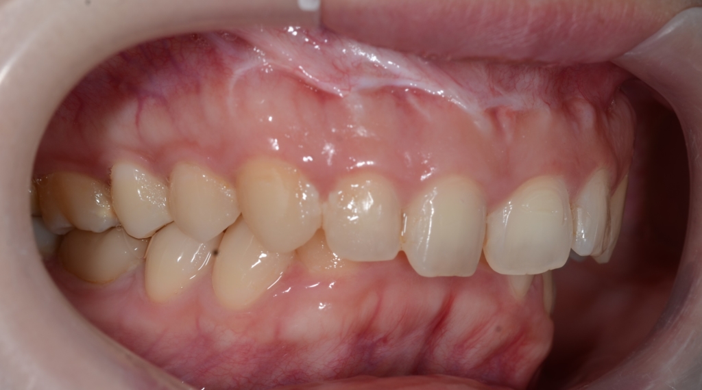 ガミースマイルで出っ歯の矯正前の歯並び