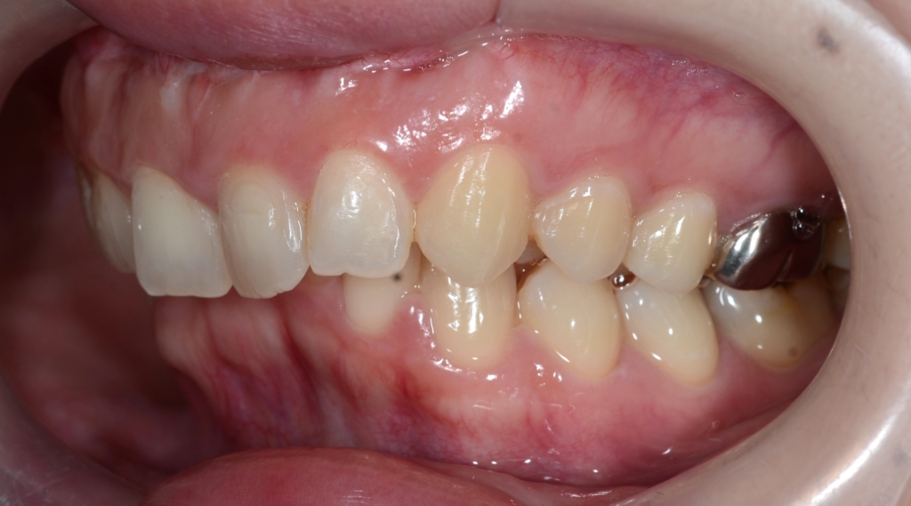 ガミースマイルで出っ歯の矯正前の歯並び