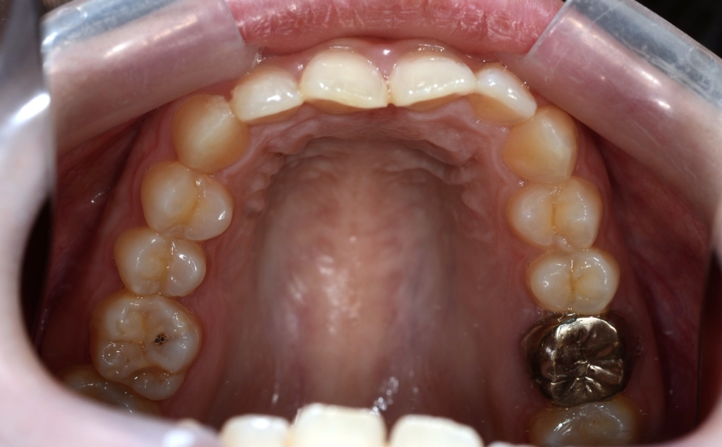 ガミースマイルで出っ歯の矯正前の歯並び