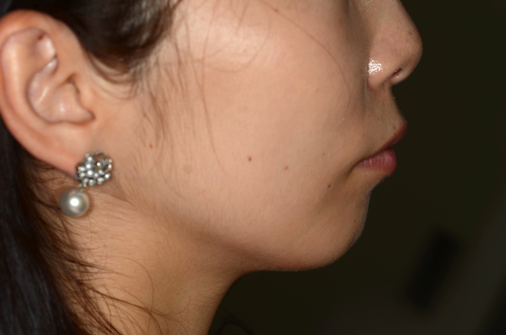 ガミースマイルで出っ歯の矯正前の横顔と口元