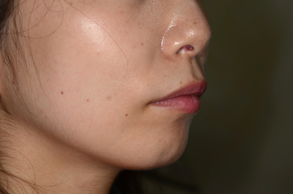 ガミースマイルで出っ歯の矯正前の横顔と口元