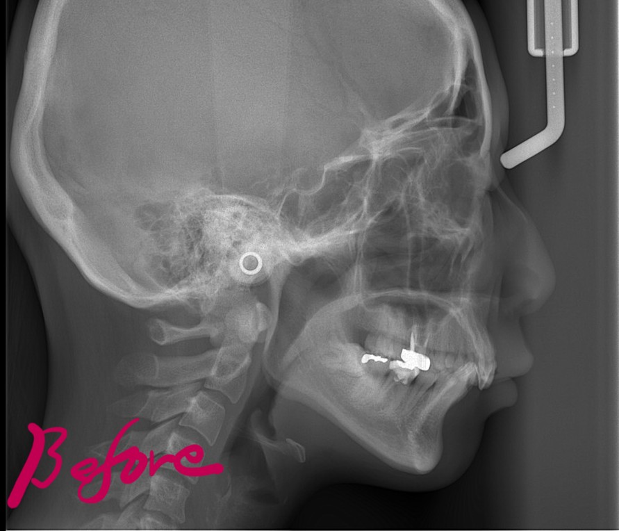 ガミースマイルで出っ歯の矯正前の頭部を横から見たレントゲン写真