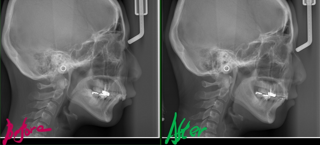 ガミースマイルで出っ歯を矯正した治療前後のレントゲン写真による比較