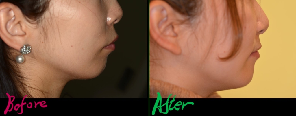 ガミースマイルで出っ歯を矯正した治療前後の横顔と口元の変化の比較