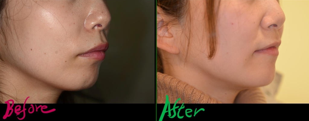 ガミースマイルで出っ歯を矯正した治療前後の横顔と口元の変化の比較