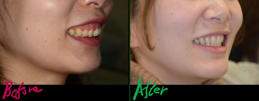 ガミースマイルで出っ歯を矯正した治療前後の笑顔の変化の比較