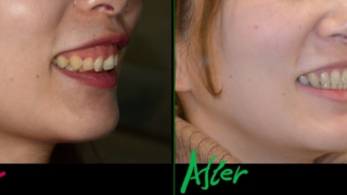 ガミースマイルで出っ歯を矯正した治療前後の笑顔の変化の比較