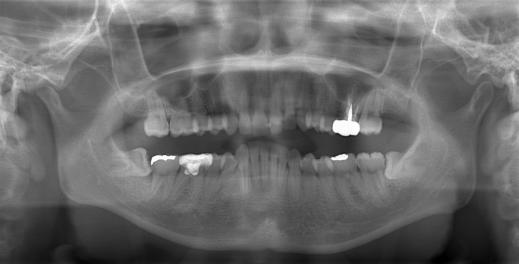 ガミースマイルで出っ歯の矯正前の顎全体のレントゲン写真