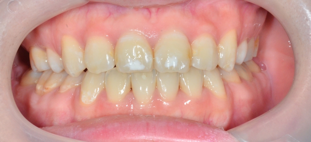 口ゴボを矯正した後の歯並び