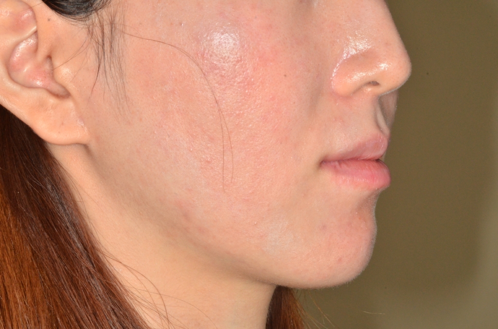 口ゴボを矯正した後の横顔と口元