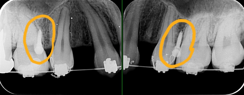 上顎の臼歯部にアンカースクリューを植立