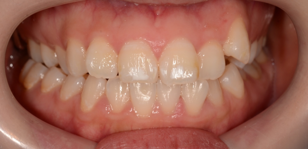 口ゴボを矯正する前の歯並び