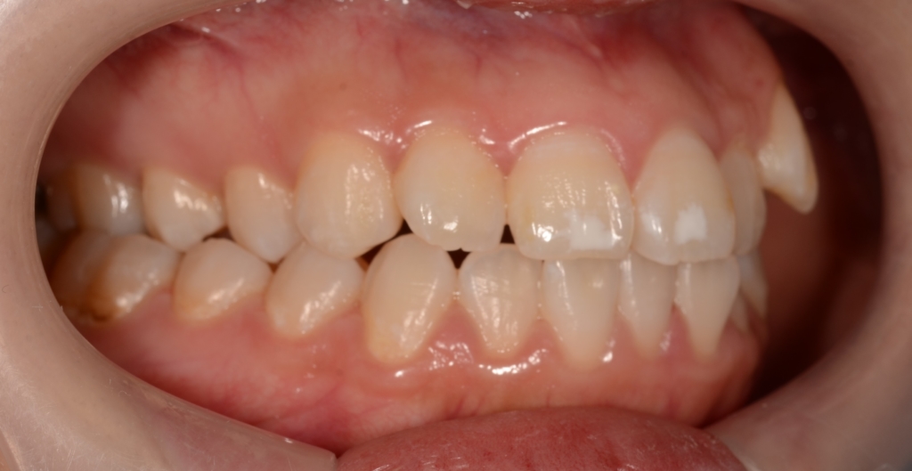 口ゴボを矯正する前の歯並び