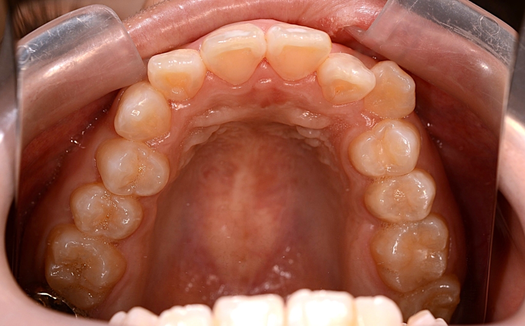 口ゴボを矯正する前の歯並び