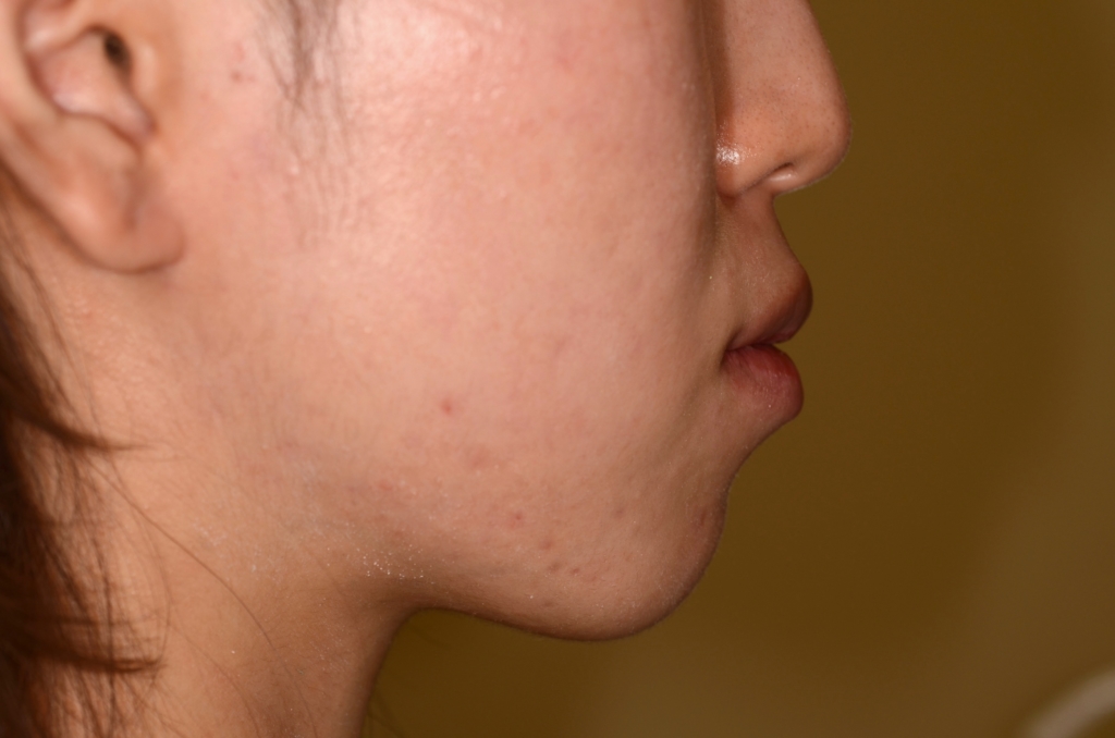 口ゴボを矯正する前の横顔と口元