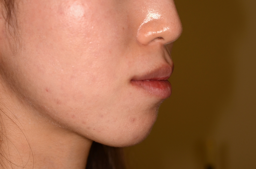 口ゴボを矯正する前の横顔と口元
