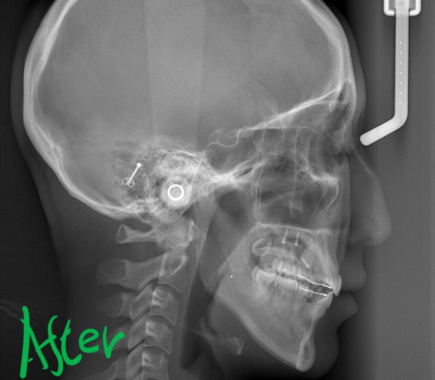 口ゴボの矯正後の頭部を横から見たレントゲン写真