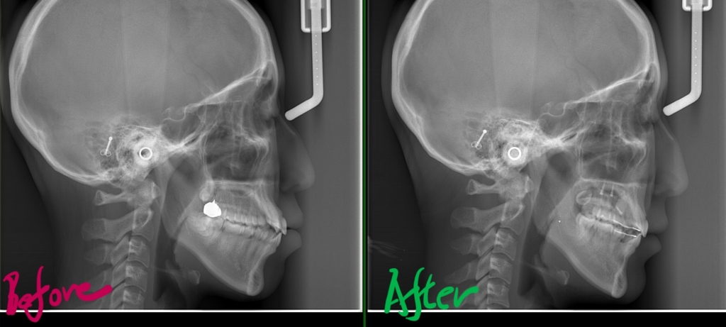 口ゴボを矯正した治療前後のレントゲン写真による比較