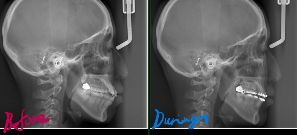 治療開始時点から便宜抜歯分だけ前歯を引っ込めたことによる横顔と口元の変化の比較