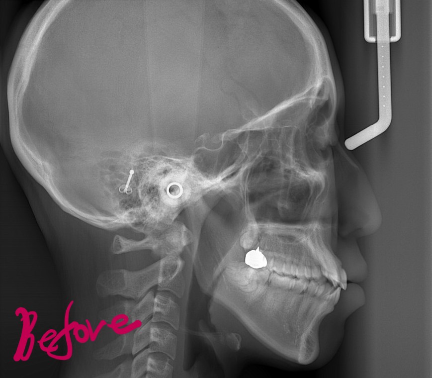 口ゴボの矯正前の頭部を横から見たレントゲン写真