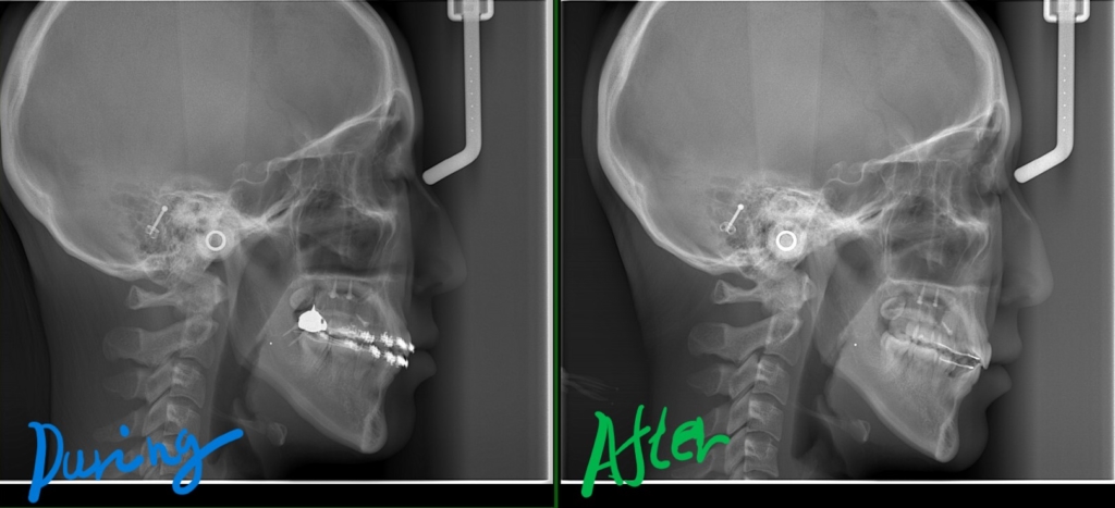 上下の歯列全体を後方へ移動させた治療に伴う変化