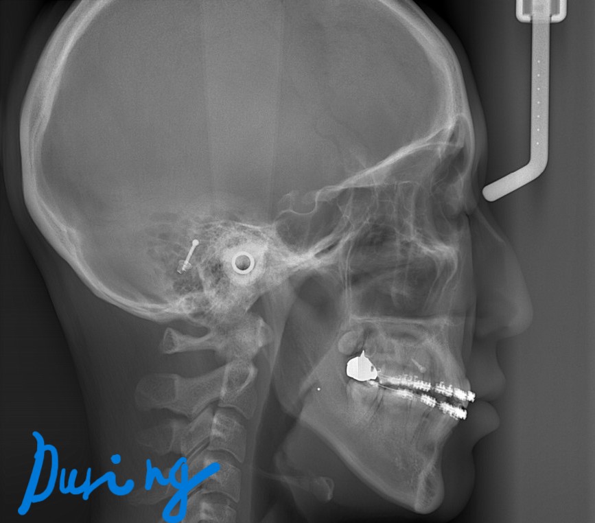 口ゴボの矯正中の頭部を横から見たレントゲン写真