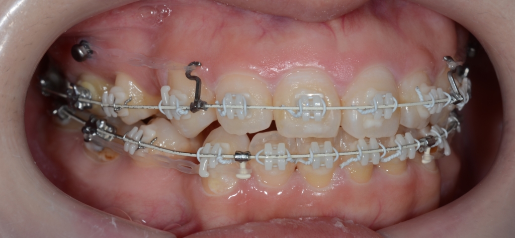 アンカースクリューを併用した矯正治療