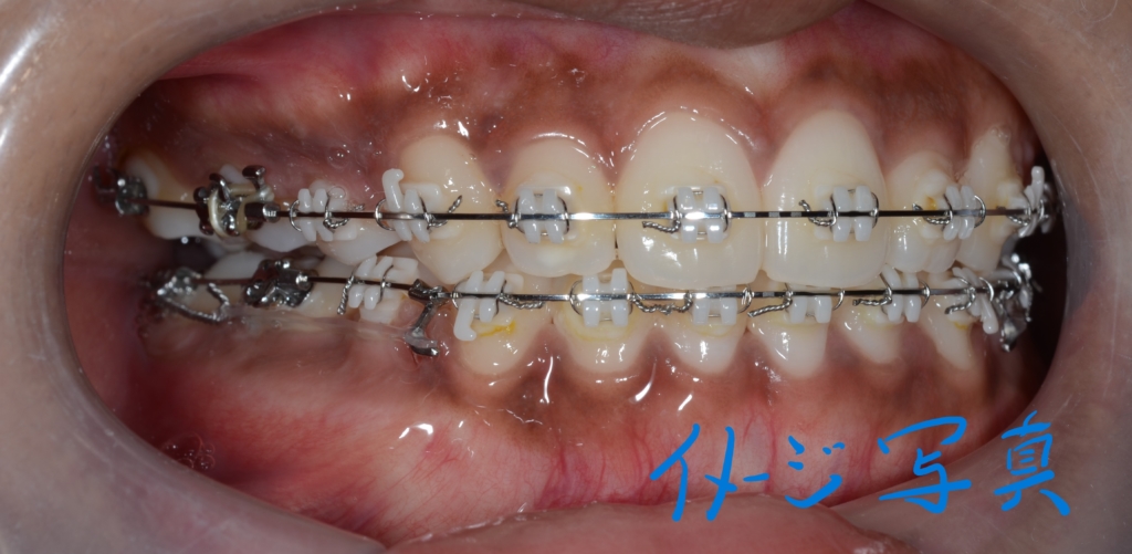 上下とも歯列全体を更に後方へ移動させる矯正治療