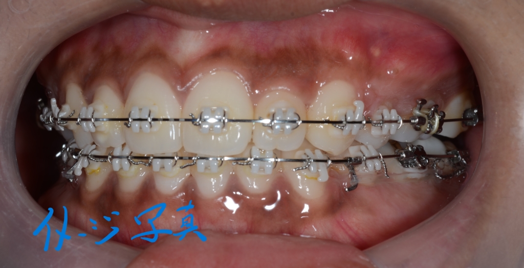 上下とも歯列全体を更に後方へ移動させる矯正治療