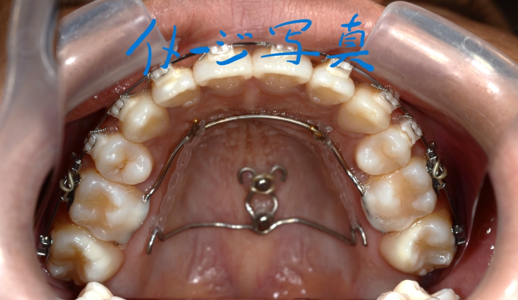 上下とも歯列全体を更に後方へ移動させる矯正治療