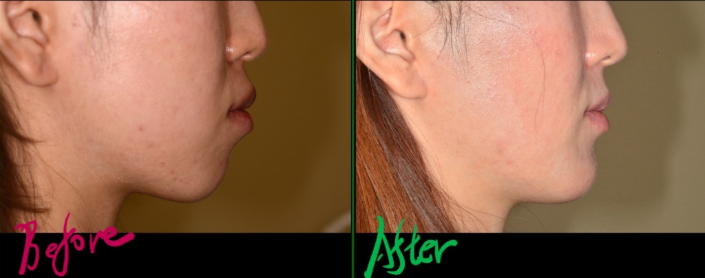 口ゴボを矯正した治療前後の横顔と口元の変化の比較