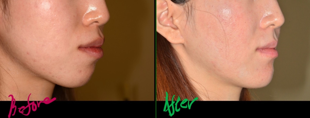 口ゴボを矯正した治療前後の横顔と口元の変化の比較