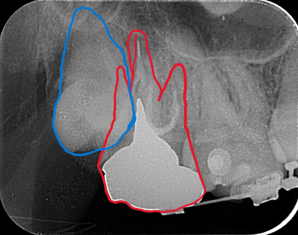 右上奥歯の現状