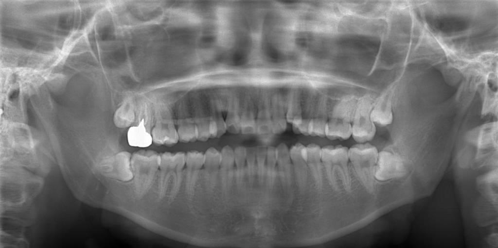 口ゴボの矯正前の顎全体のレントゲン写真